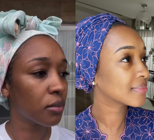 Skincare transformation using Mira products